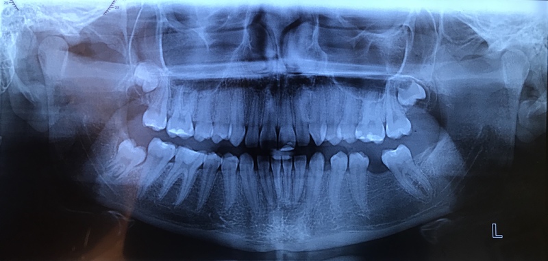 Figura_1_Radiografia panoramica inicial.jpg